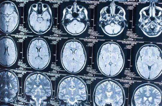 Avancée majeure dans la connaissance du cerveau : création d’une banque d’images de référence par IRM
