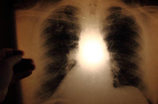 Tuberculose : trois cas confirmés dans un lycée d’Anglet