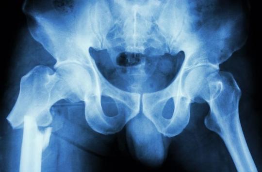 Un simple questionnaire protège les personnes âgées des fractures de la hanche