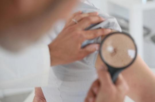 Cancer de la peau : 300 dermatologues s'ouvrent au public