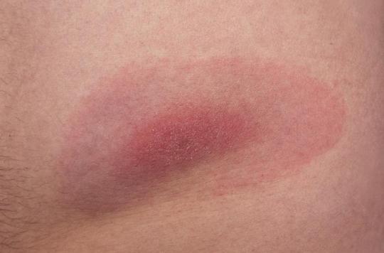 Maladie De Lyme 300 Malades Portent Plainte Contre L Etat Et Contre La Science