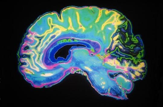 Alzheimer : la perte en neurones est paradoxalement très limitée