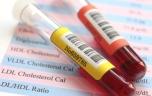 Hypercholestérolémie familiale : l’importance du dépistage précoce 