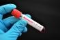 Virus : un premier cas de variole du singe identifié en Corse