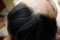Chute de cheveux chez les femmes de 50 ans : principales causes et solutions 