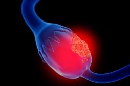 Cancer des ovaires : un traitement permet de préserver la fertilité