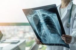 Covid : des anomalies pulmonaires trouvées chez des patients asymptomatiques