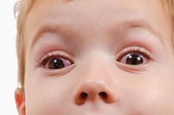 Des ophtalmologues alertent sur de graves brûlures aux yeux chez des enfants à cause du gel hydro-alcoolique
