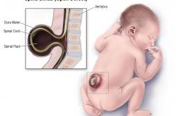 Le spina bifida, une malformation du foetus qui laisse le bas de sa colonne vertébrale à nu