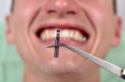  L’ANSM retire du marché des implants dentaires