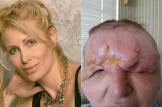   Florida woman disfigured after cosmetic surgery