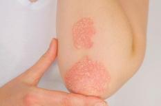 Psoriasis : une maladie inflammatoire de la peau et des ongles à traiter