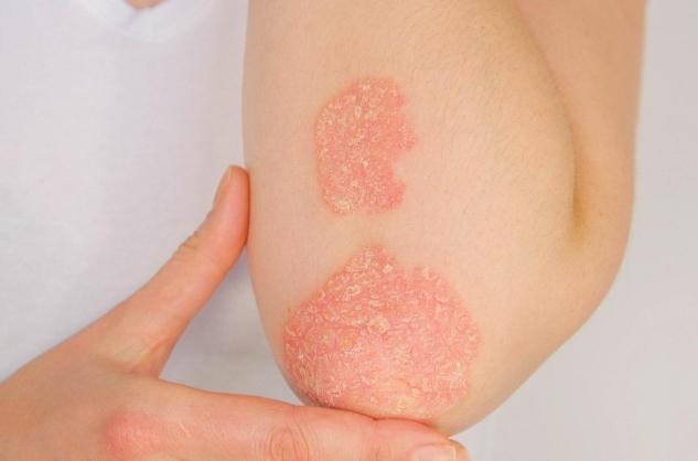 Psoriasis : une maladie inflammatoire de la peau et des ongles à ...