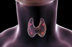 Hyperparathyroïdie primitive : une élévation du calcium dans le sang