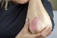 Psoriasis : une maladie inflammatoire de la peau et des ongles à traiter